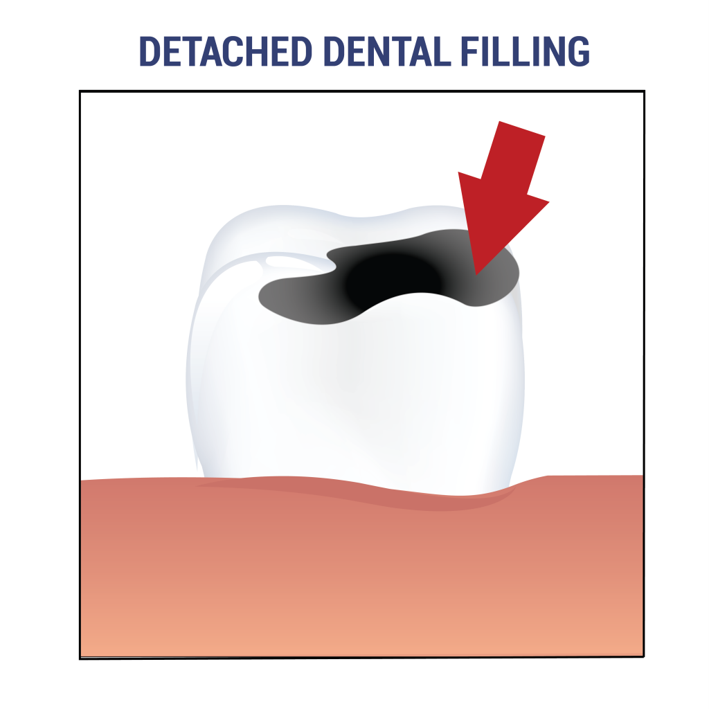 Dentafix Temporary Filling Material The Smile Boutique